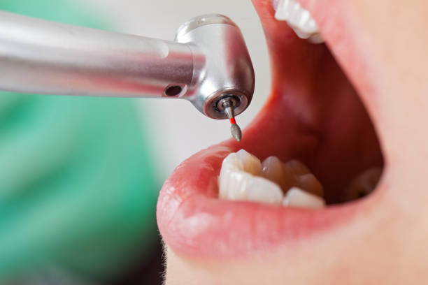 Best Emergency Dentist for Lost Fillings or Crowns in Basye, VA